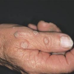 Example of skinLumpsAndBumps